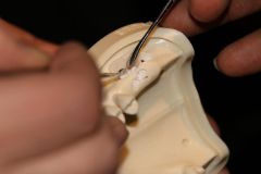 Maxillary Sinus Grafting_8