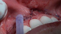 perio esthetic surgery Esthetic crown lengthening_14