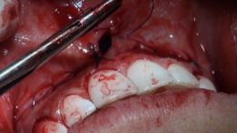 جراحی افزایش طول و طراحی لبخند - اردیبهشت ۹۷