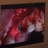 دوره پیشرفته ایمپلنت های فوری و بازسازی زیبایی - شهریور ۹۵