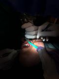 Sinus graft course with live surgey