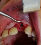 معرفی سیستم SPI همراه با جراحی زنده و Immediate Loading - آبان ۹۵