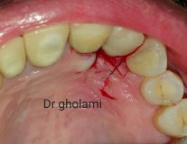 SPI system presentation with live surgery_23