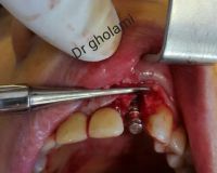 SPI system presentation with live surgery_9